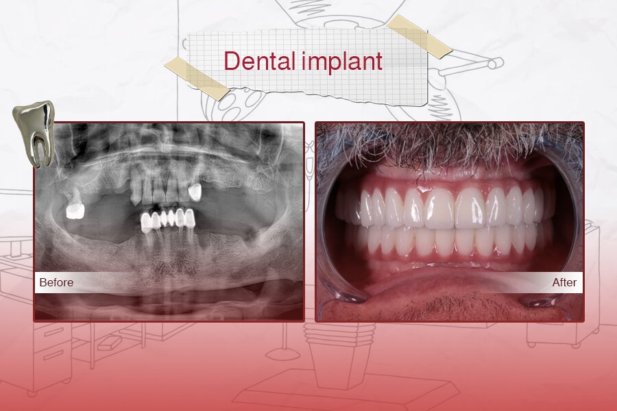 best implants in turkey