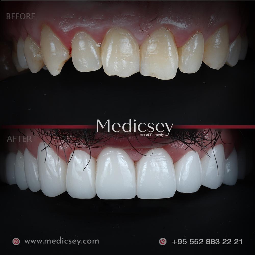 veneers cost turkey