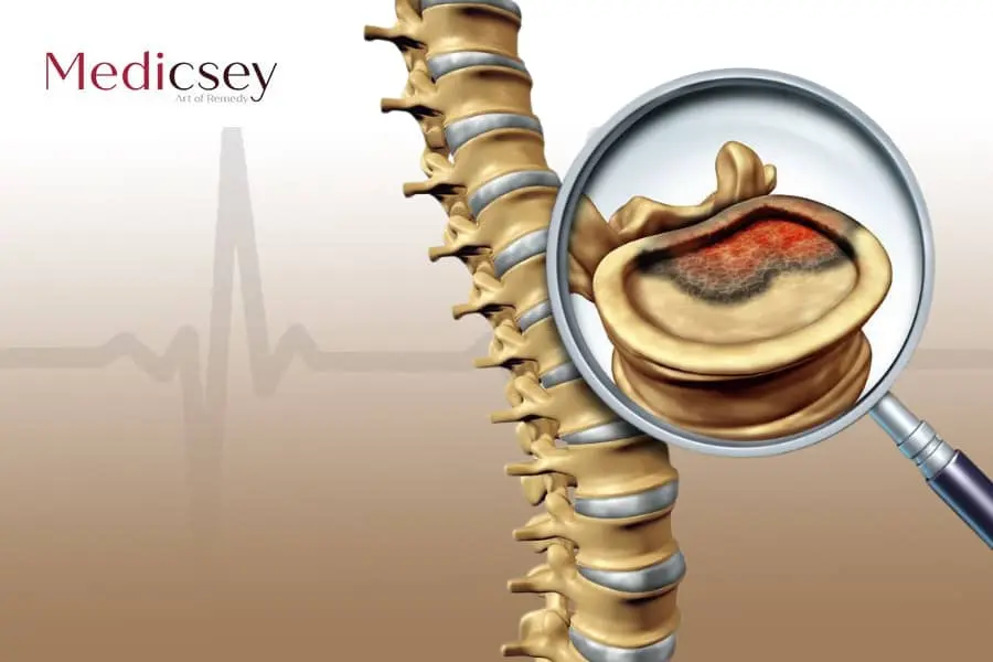 Causes and Treatment of Bone Cancer in Turkey 