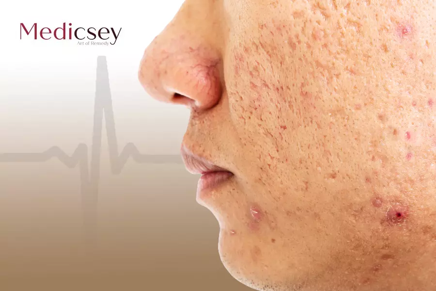 Causes and treatment of rosacea in turkey