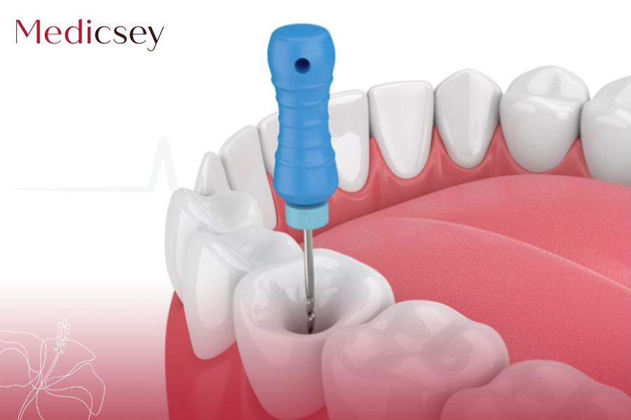  Root Canal Treatment