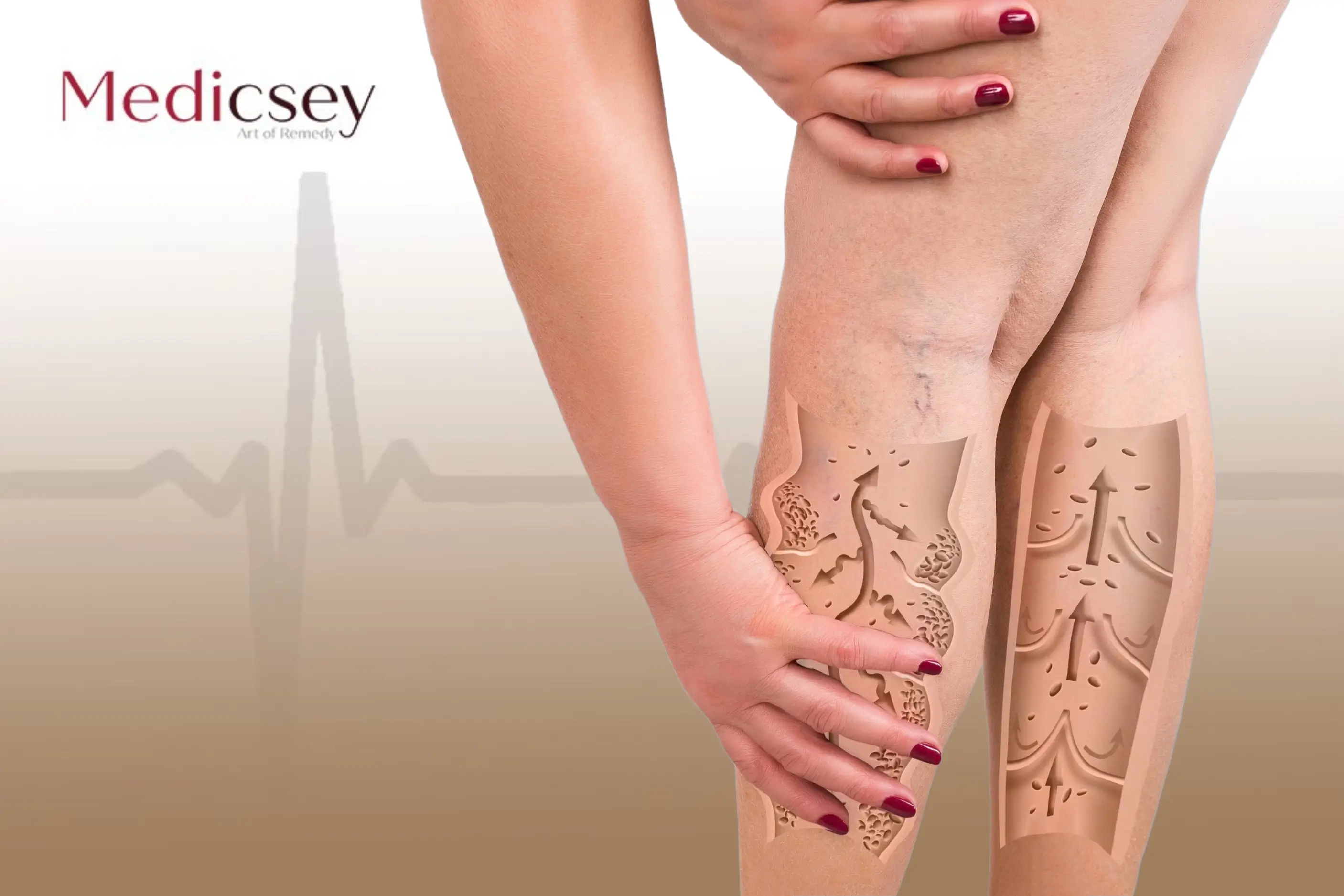 Causes and treatment of Varicose veins in turkey 