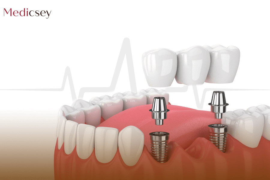 Dental Implants