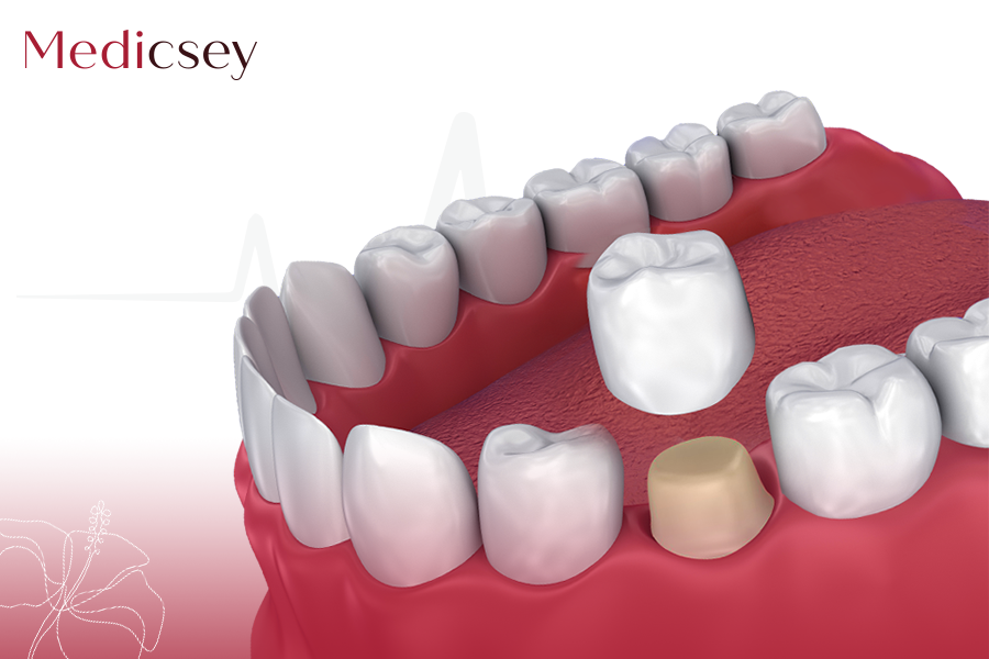 Zirconium Crowns