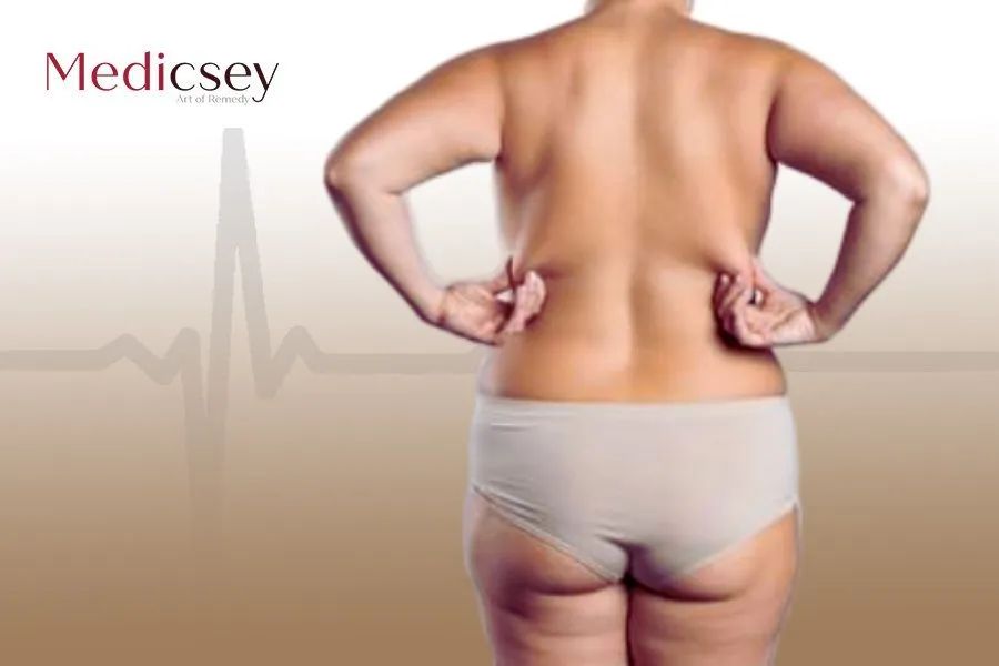 Back Fat Lipo in Turkey: The Best Procedure in 2023