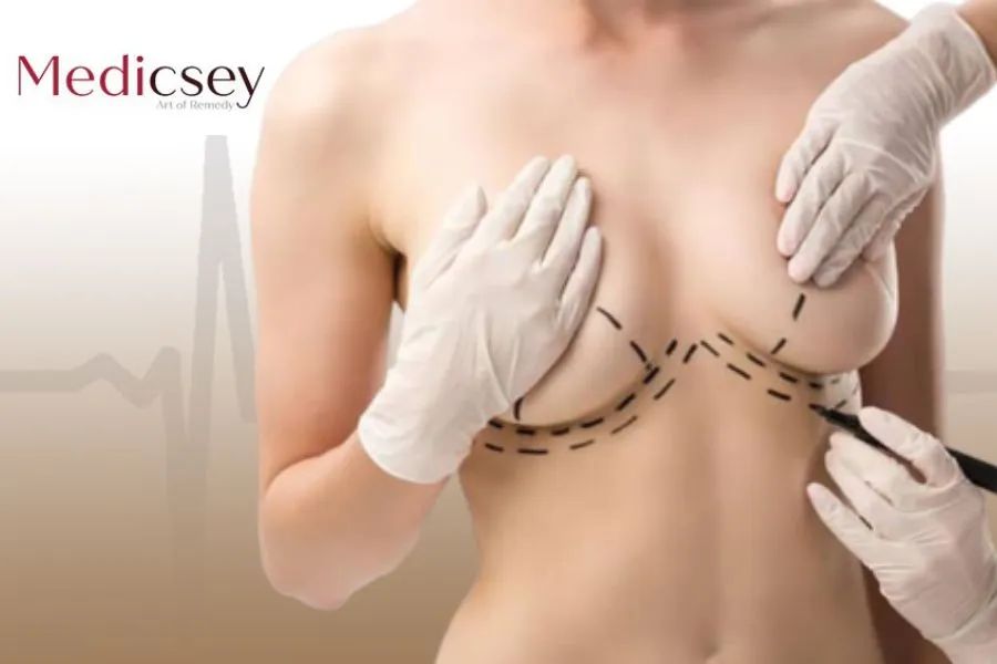 Mastopexy cost in Turkey: The Full Guide in 2024