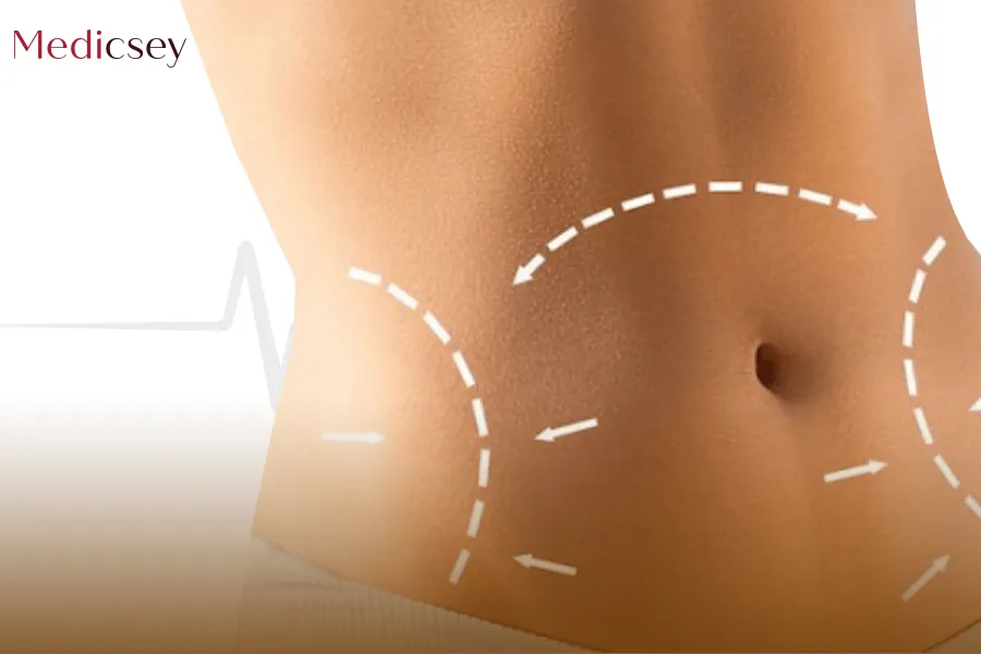 Tummy Tuck