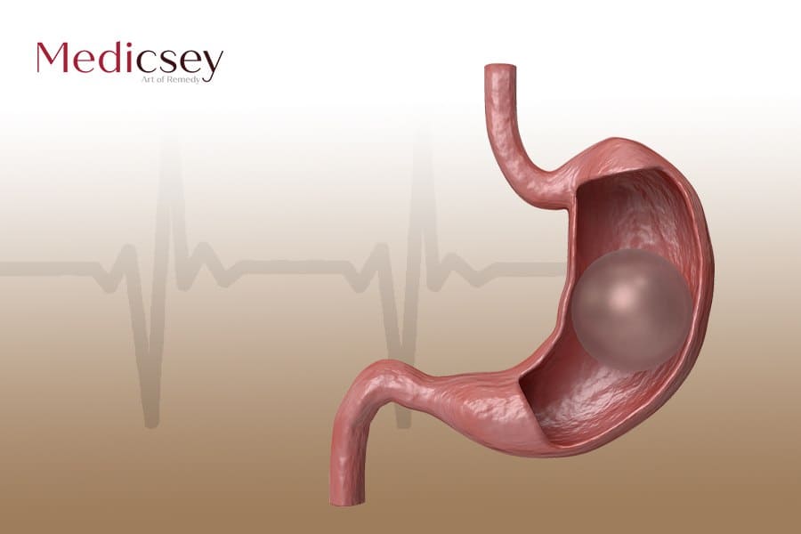 Diet after gastric balloon procedure in Turkey