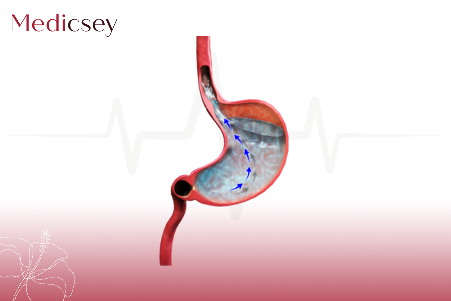 GASTRO ESOPHAGEAL REFLUX DISEASE (GERD)