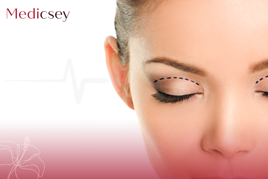 Blepharoplasty Cost in Turkey