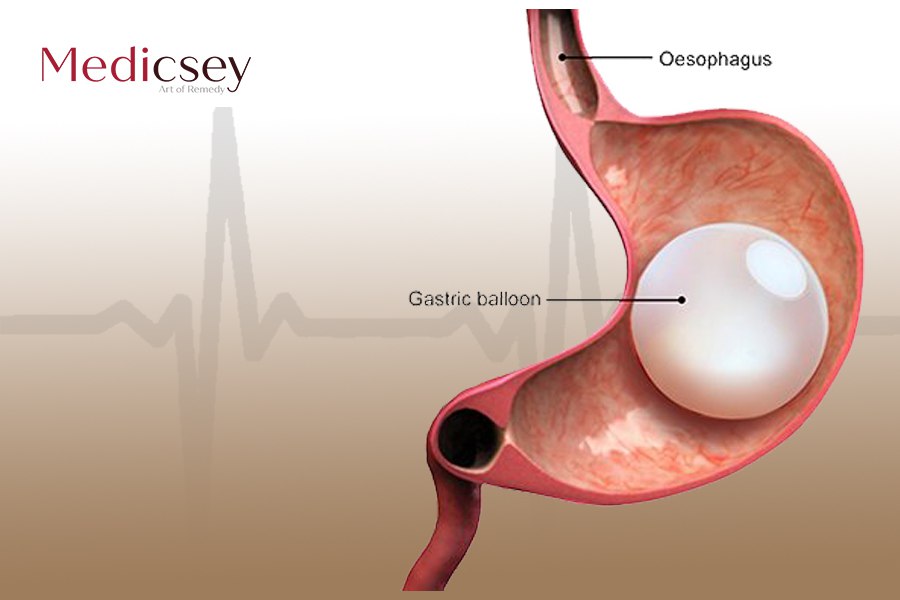 Swallowable Gastric Balloon in Turkey