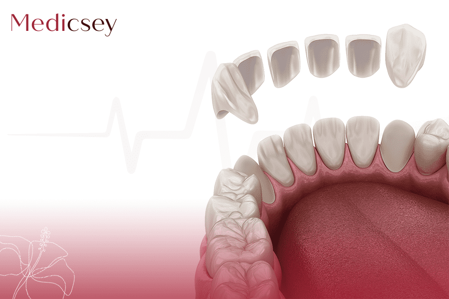 Porcelain Veneers Cost In Istanbul