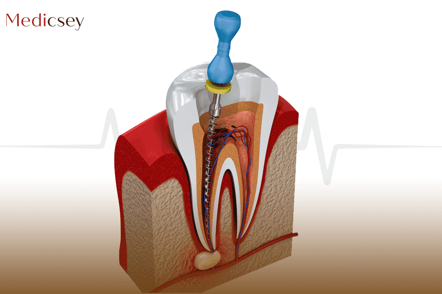 Dental filling prices in Turkey