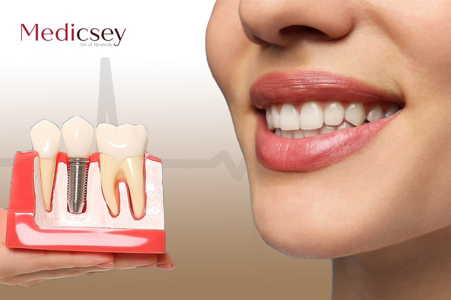 Full mouth dental implants in Turkey